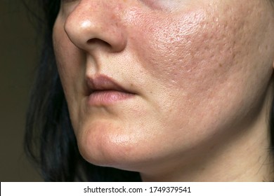 Woman With Problematic Skin And Acne Scars. Pigmentation On Face Woman. Problem Skin Care And Health Concept. 