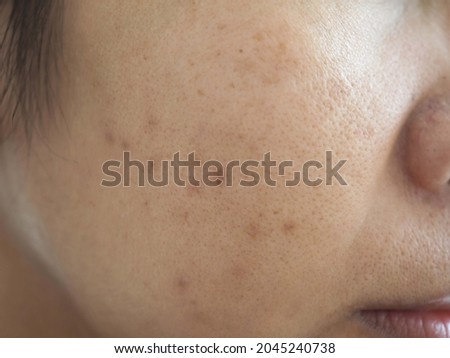 Woman with problematic skin and scars from acne. concept of facial and beauty products. closeup photo, blurred.