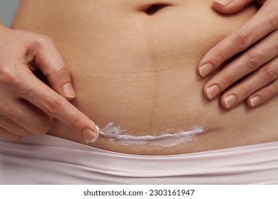 woman putting healing cream in the c-section scar of caesarean