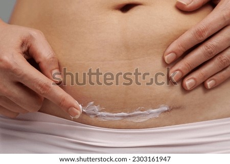 woman putting healing cream in the c-section scar of caesarean