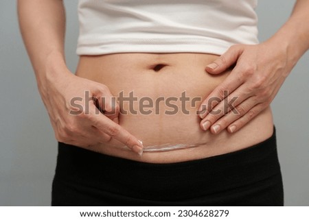 woman putting healing cream in the c-section scar of cesarean