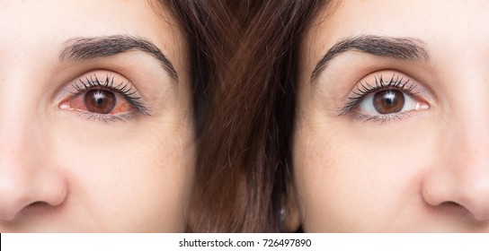 Woman With Red Eye Before And After Use Of Eyewash