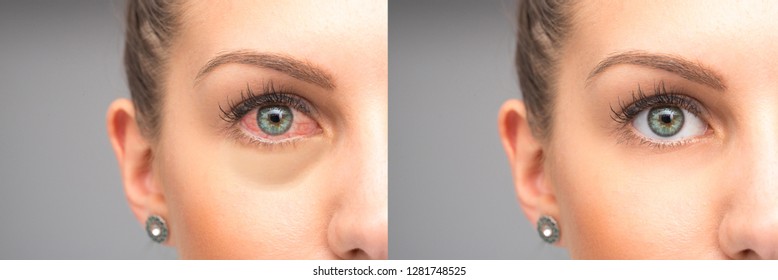 Woman Red Eyes Before And After Eye Drops Wash