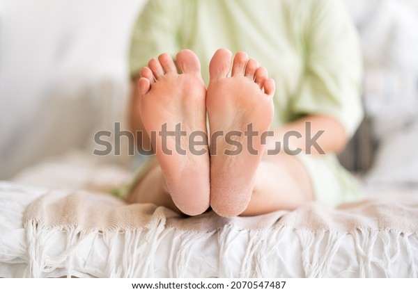 Woman relaxing in\
bedroom, female feet with dry cracked skin close-up, foot care\
concept, home interior