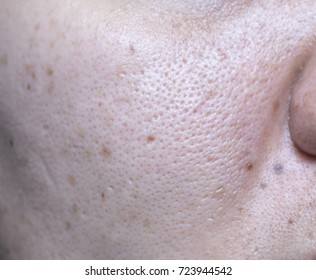 Woman 's Problematic Skin , Acne Scars ,oily Skin And Pore And Blackhead On The Face.