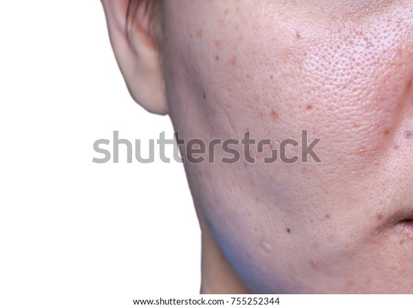女性の肌の問題 ニキビの傷 脂っこい肌と毛穴 黒い斑点 黒い頭と白い頭の顔 の写真素材 今すぐ編集