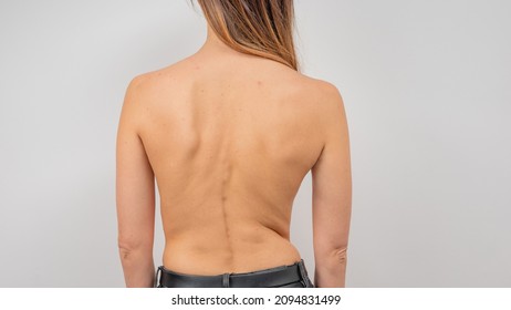Woman with scoliosis of the spine. Curved woman's back with acne skin. - Shutterstock ID 2094831499
