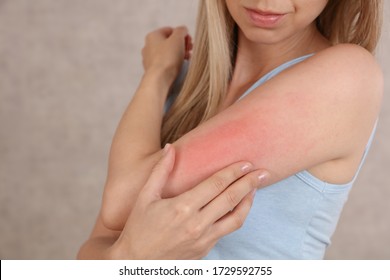 Woman Scratching An Itch Close Up . Sensitive Skin, Food Allergy Symptoms, Irritation