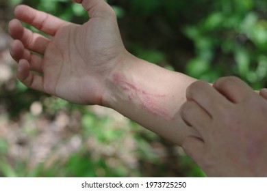 A Woman Scratching Very Itchy Poison Ivy While Hiking In The Woods