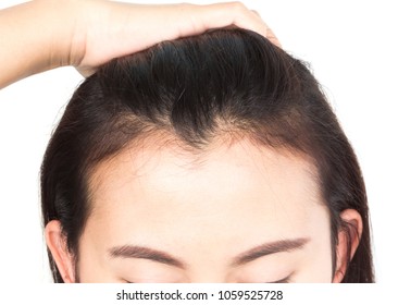 Receding hairline girl