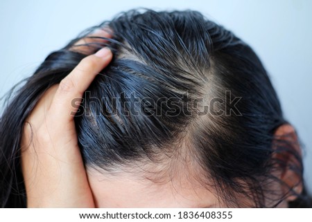 Woman serious thin hair problem for health care.