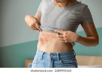 Woman with shingles on the skin she feels very painful