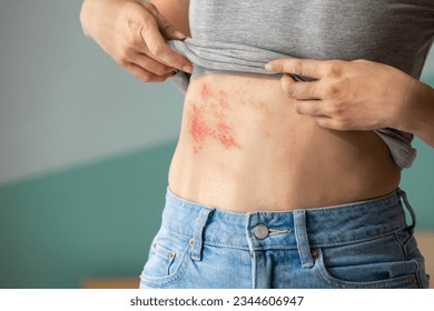 Woman with shingles on the skin she feels very painful