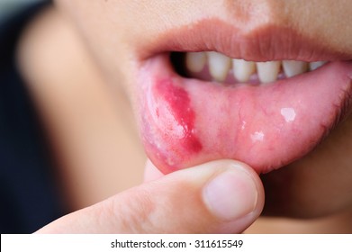 Woman Show Her Lower Lip Of The Mouth With Injury