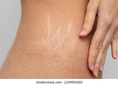Woman show her Stretch marks on the body. - Shutterstock ID 2159093303