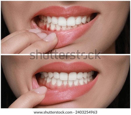 Woman showing gum before and after treatment, collage of photos