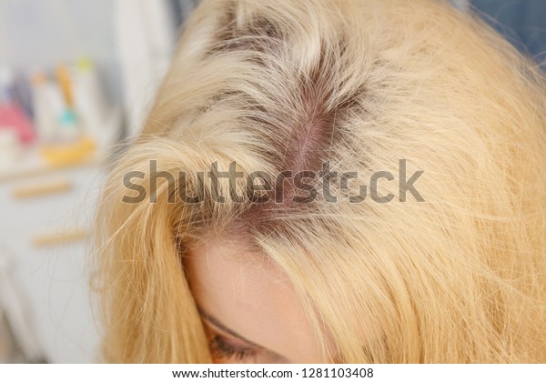 Woman Showing Her Hair Regrowth Roots Stock Image Download Now