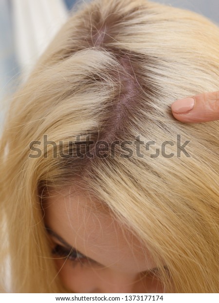 Woman Showing Her Hair Regrowth Roots Stock Photo Edit Now