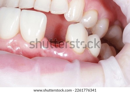 Woman showing mouth without broken tooth. Gap toothed. High quality close up photo