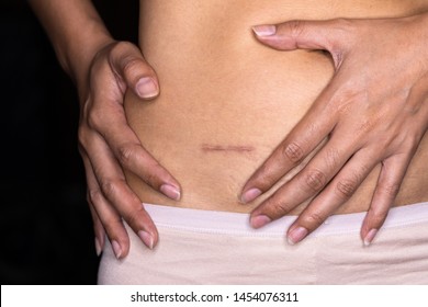 Woman showing on your stomach with a appendicitis scar, Appendicitis scar on the woman stomach.