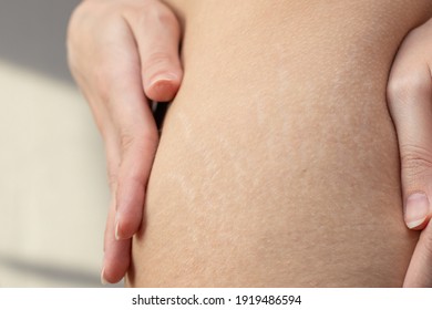 Woman showing stretch marks on her body. Stretch marks scars on the skin of the hips. - Shutterstock ID 1919486594