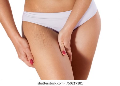 Woman Showing Stretch Marks On Legs 