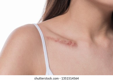 woman  showing surgery scar. Scars removal concept, close up, selective focus