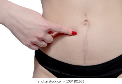 woman showing surgery scar. Scars removal concept, close up, selective focus