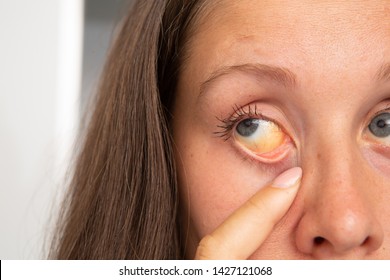 Woman Showing Symptoms Of Jaundice In The Eyes