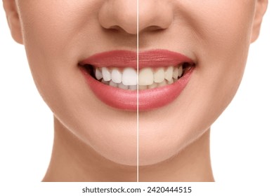 Woman showing teeth before and after whitening on white background, collage - Powered by Shutterstock