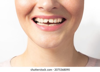 Woman shows broken tooth. Close up photo. 
