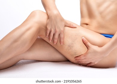 A Woman Shows A Capillary Mesh On Her Legs. Treatment Of The Expansion Of Small Vessels In The Legs. Medical Examination And Treatment Of Telangiectasias. Phleberism.