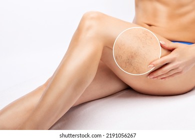 A Woman Shows A Capillary Mesh On Her Legs. Treatment Of The Expansion Of Small Vessels In The Legs. Medical Examination And Treatment Of Telangiectasias. Phleberism.