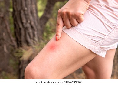 woman shows her finger at an insect bite. The leg with red spot caused by insect bite on leg skin. Insect Bite. concept of protection from insect bites