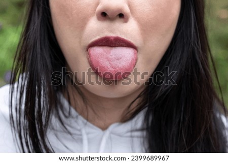 Woman shows large swollen tongue. Allergic reaction, Close-up swelling of the tongue. Allergic reactions, Infections, Angioedema, Trauma.