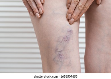 photos varices jambes