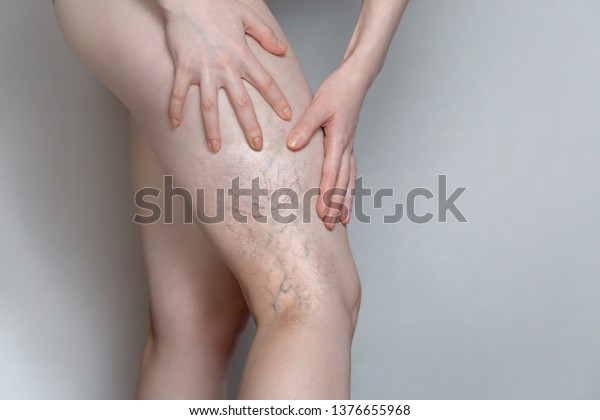 Woman shows leg with varicose\
veins. The concept of human health and disease. Gray\
background.