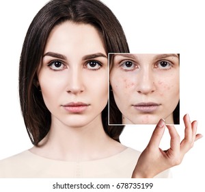 Woman Shows Photo Bad Skin Before Stock Photo 678735199 | Shutterstock