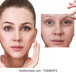 Woman Shows Photo With Bad Skin Before Treatment.