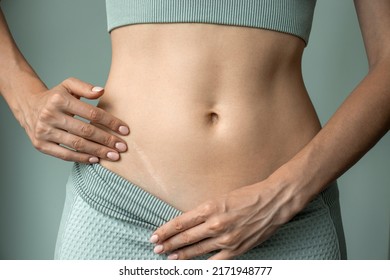 A woman shows a scar from appendicitis on her stomach