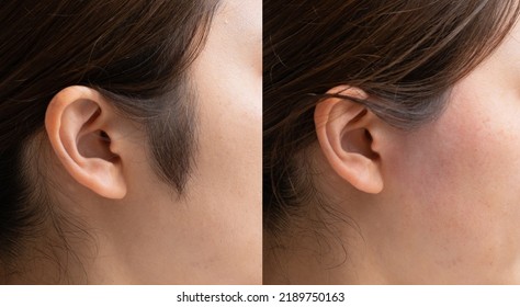 woman with sideburns hair removal