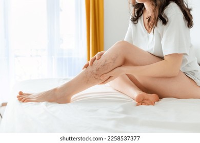 Woman sitting on bed and shows her beautiful legs with varicosity. Concept of laser epilation and varicose.