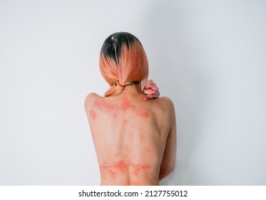 Woman With Skin Allergy All Over Her Body Showing Her Back Part With Red Rash And Skin Infection.
