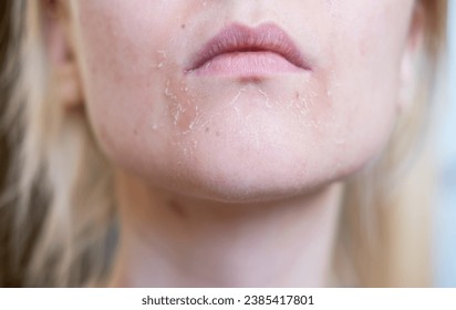 The woman skin flakes off at the mouth. Dry skin. Face skin irritation after peeling, after cold windy weather. Front view - Shutterstock ID 2385417801
