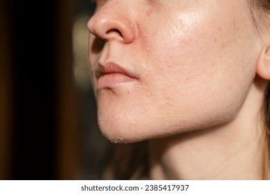 The woman skin flakes off at the mouth. Dry skin. Face skin irritation after peeling, after cold windy weather. Dark background, side view