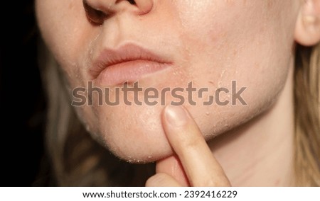 The woman skin flakes off at the mouth. Dry skin. Face skin irritation after peeling, after cold windy weather. Dark background, view by profile. 