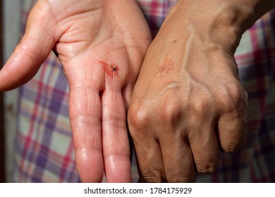 Woman Slapping A Mosquito By  Her Hand.