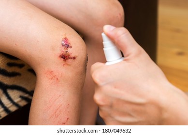 Woman Sprays An Antiseptic Agent On The Wound On The Childs Knee. Treatment The Wound. First Aid.