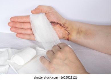 Woman with a stitched wound is changing her wound dressing