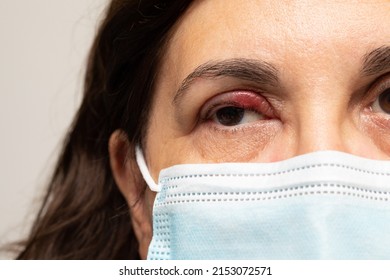 A Woman With Stye In Her Eyelid